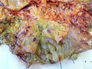 sezione di tessuto adiposo con linfonodo